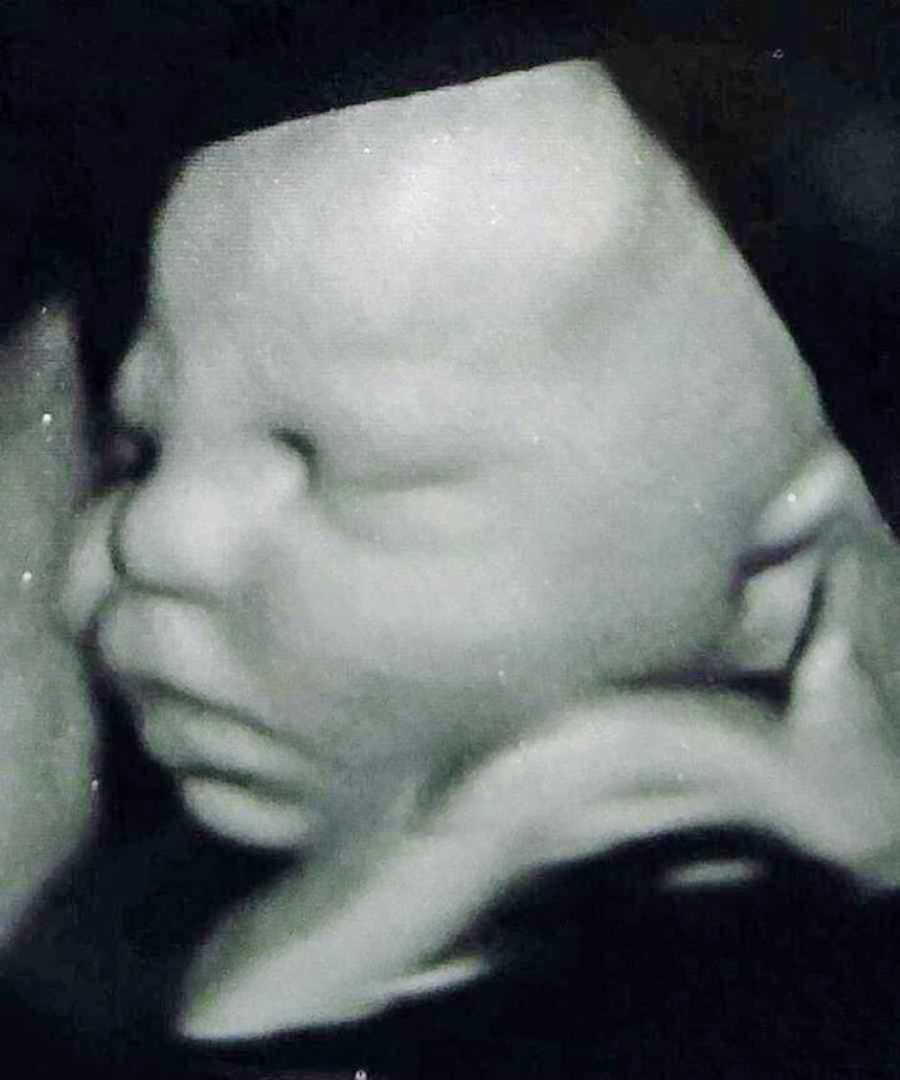 3D ultrasound scan of a baby boy in a pregnant woman's stomach