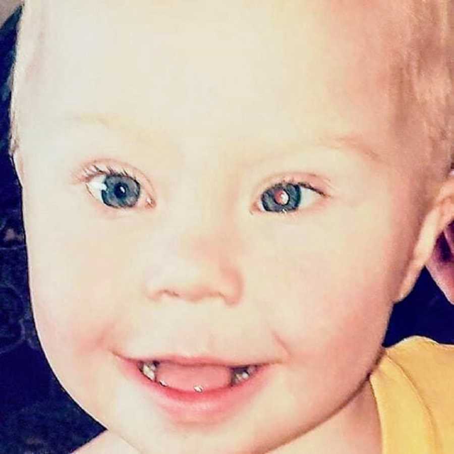 Young boy with down syndrome and Retinoblastoma