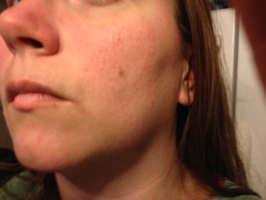 lupus butterfly rash