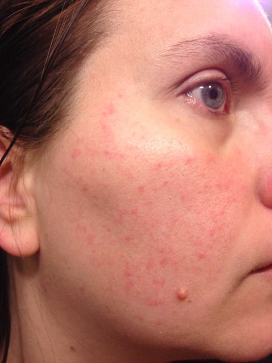 lupus butterfly rash