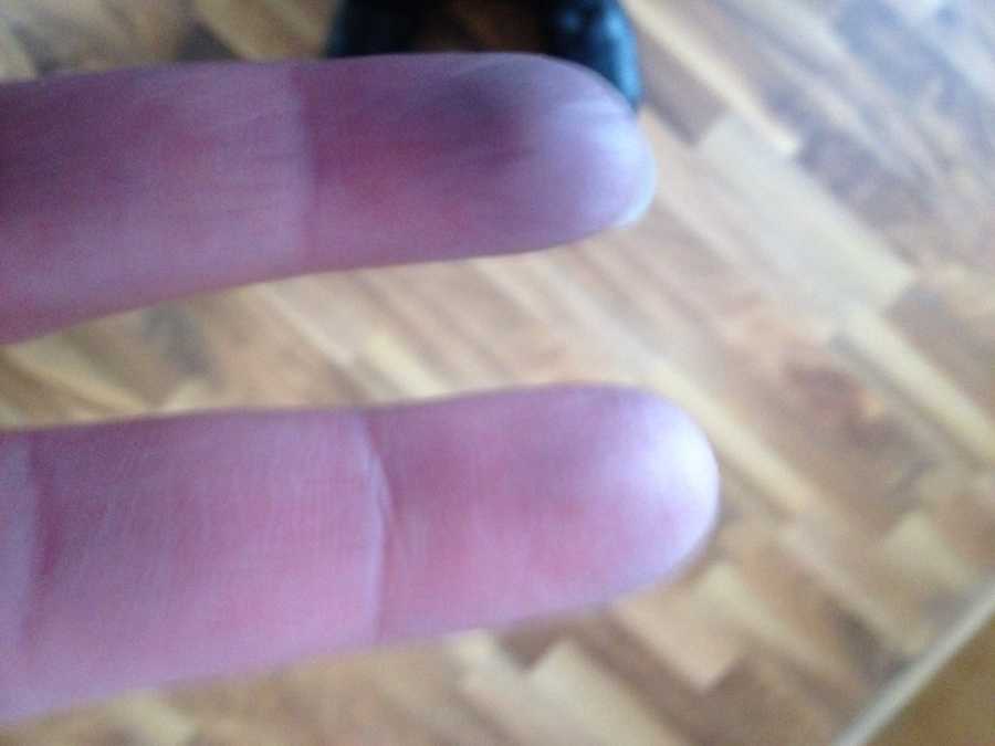 Raynauds fingers