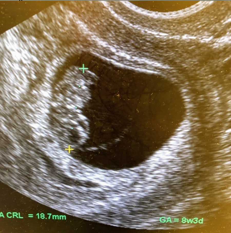 Ultrasound image