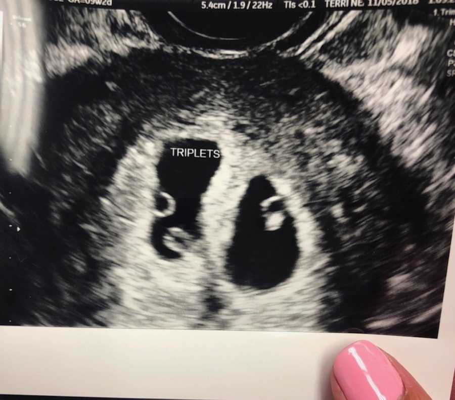 Triplet ultrasound