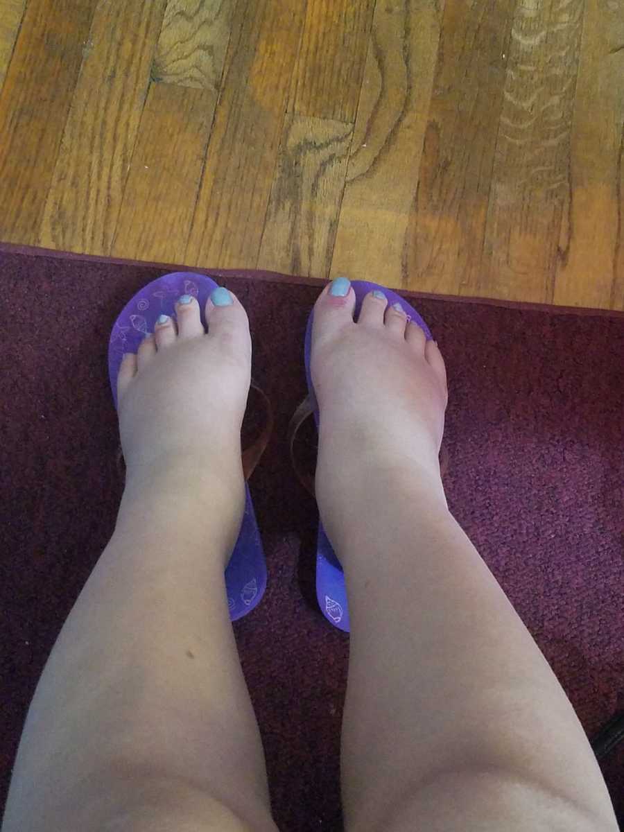 woman's swollen feet- lupus