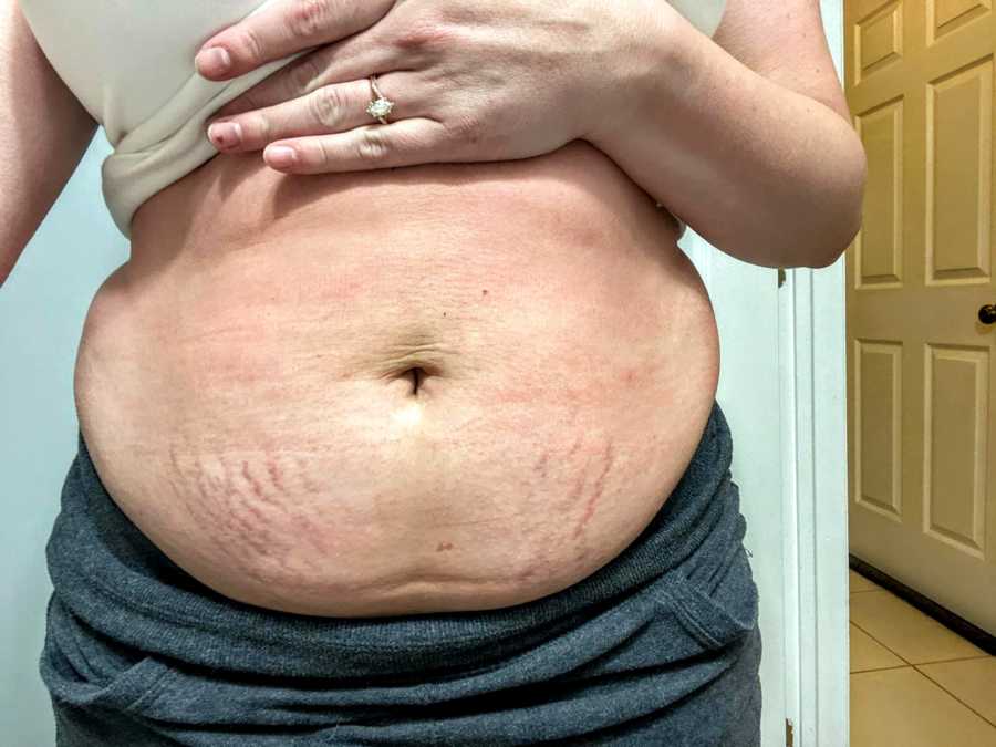 Mom embraces her mom bod in a candid photo of her postpartum belly, showing off her stretch marks