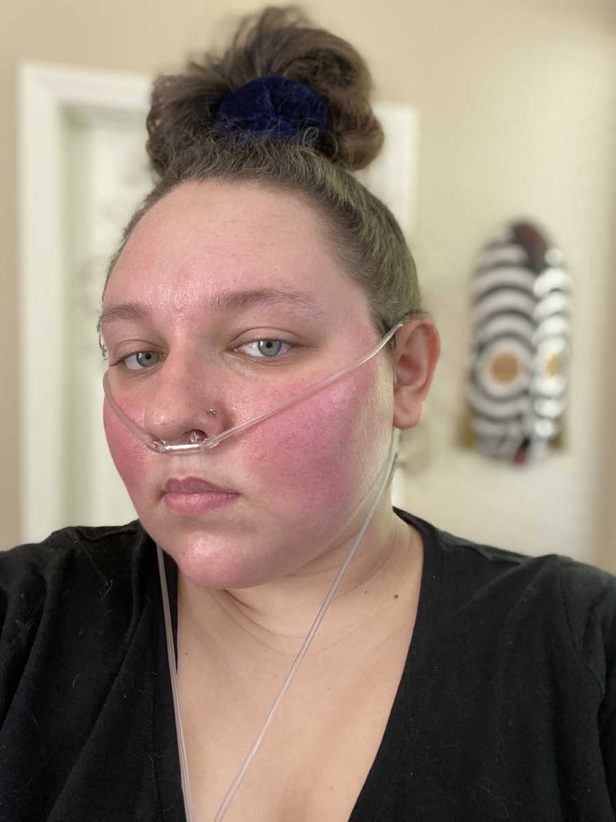 girl with malar lupus rash and breathing tube