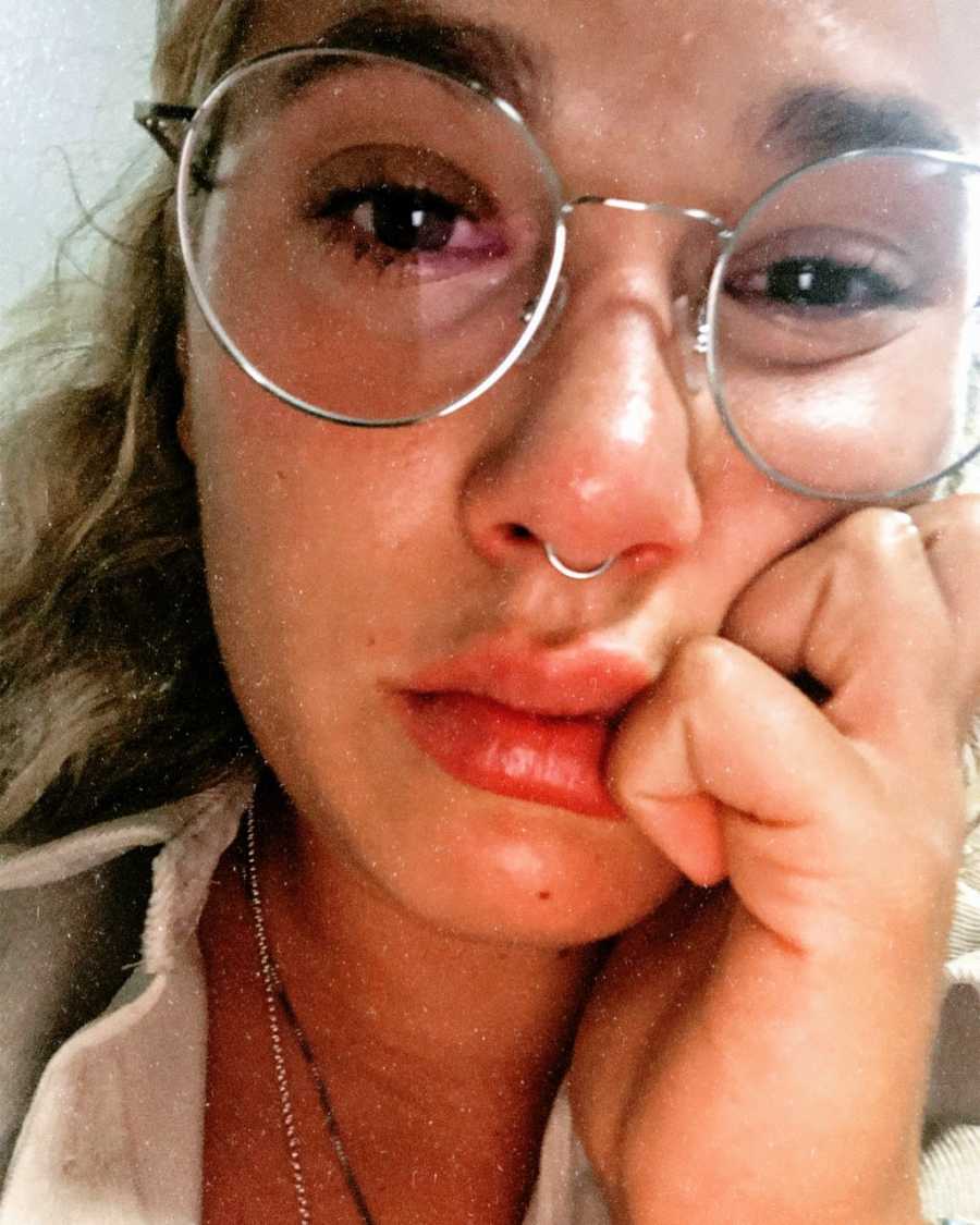 Woman with Epstein-Barr Virus takes a serious selfie while crying