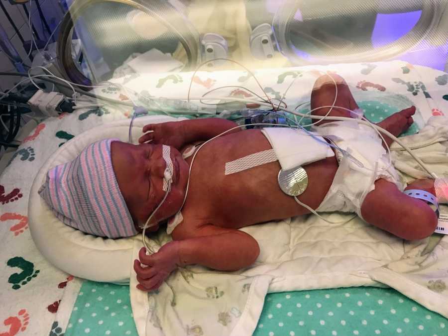 A premature baby boy with wires attached in the NICU