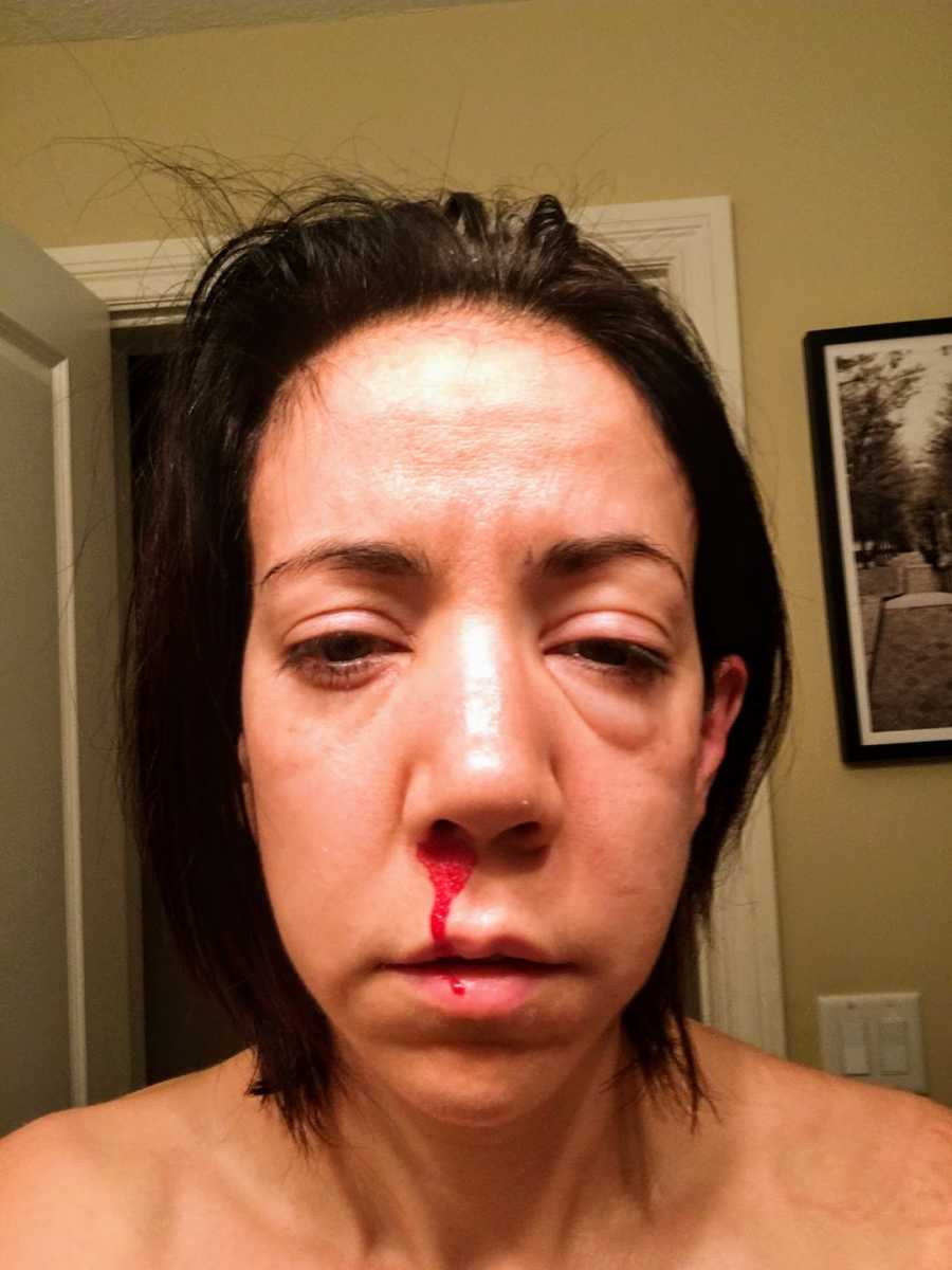 Woman with nosebleed