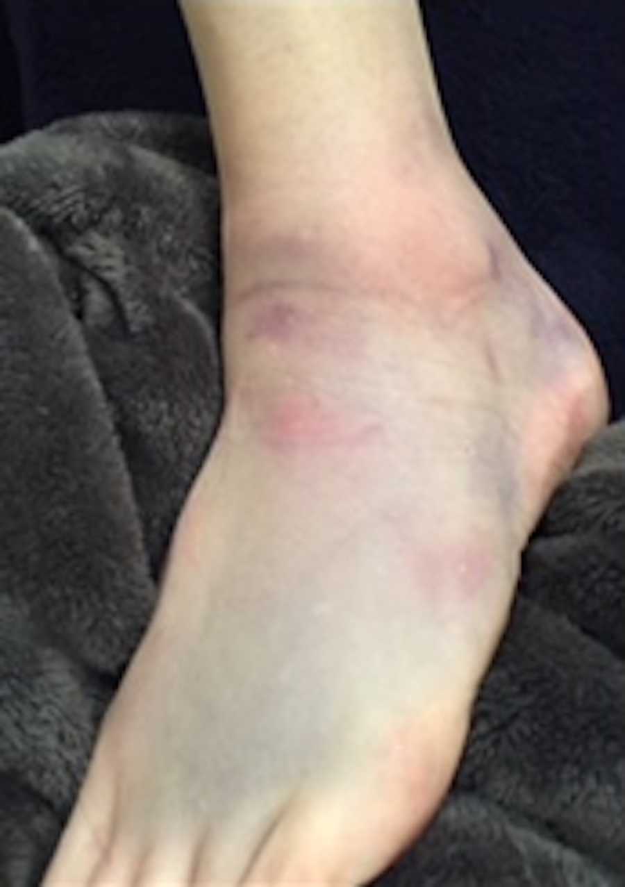 bruised foot- lupus