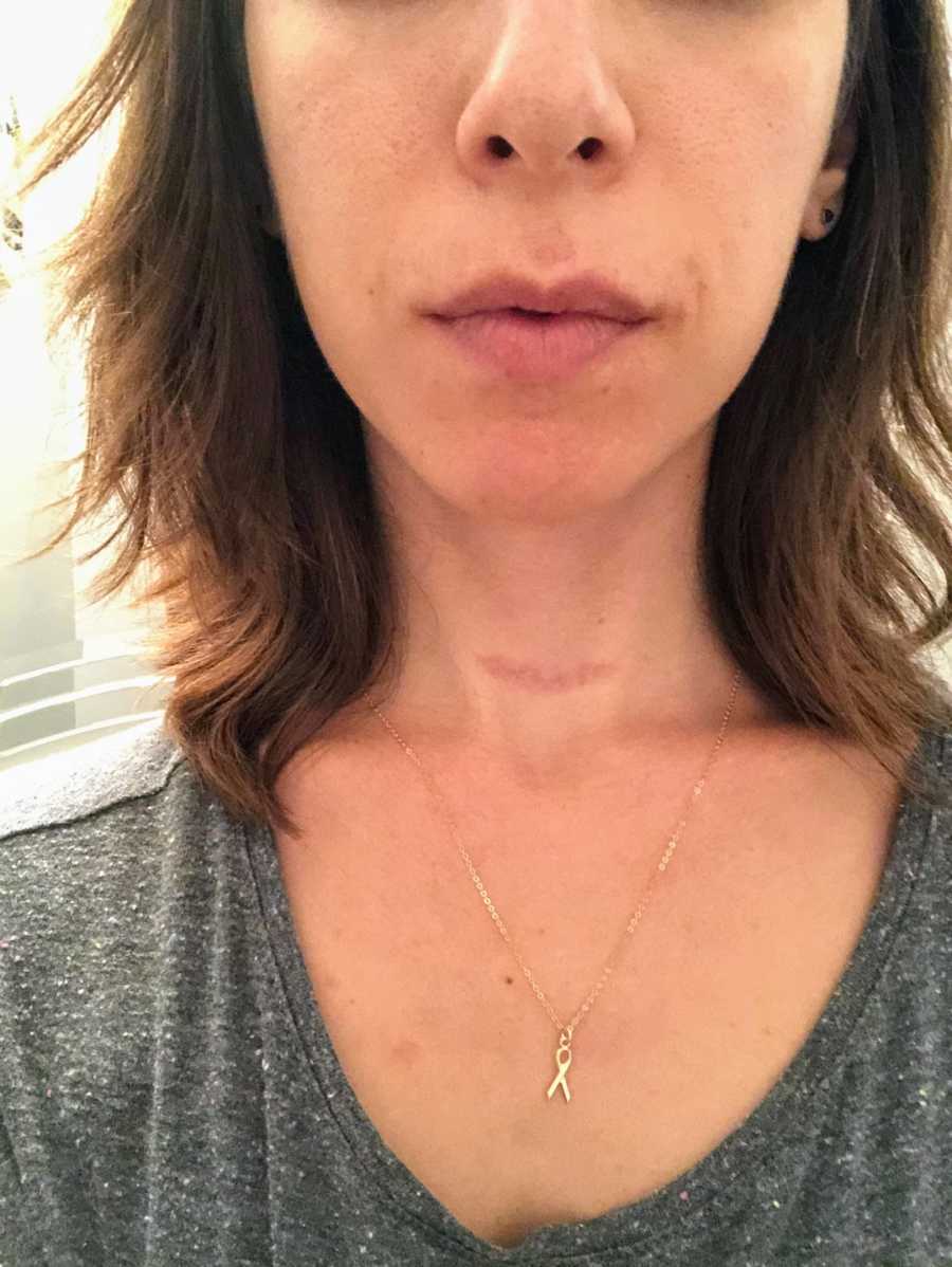 Woman's throat with scar and gold cancer awareness necklace