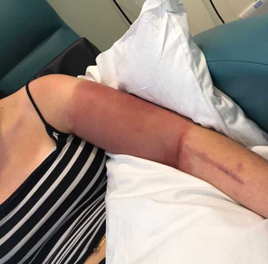 girl with bruising on arm