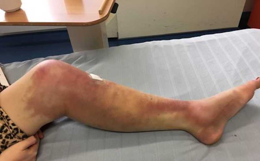 woman with severe bruising in her leg