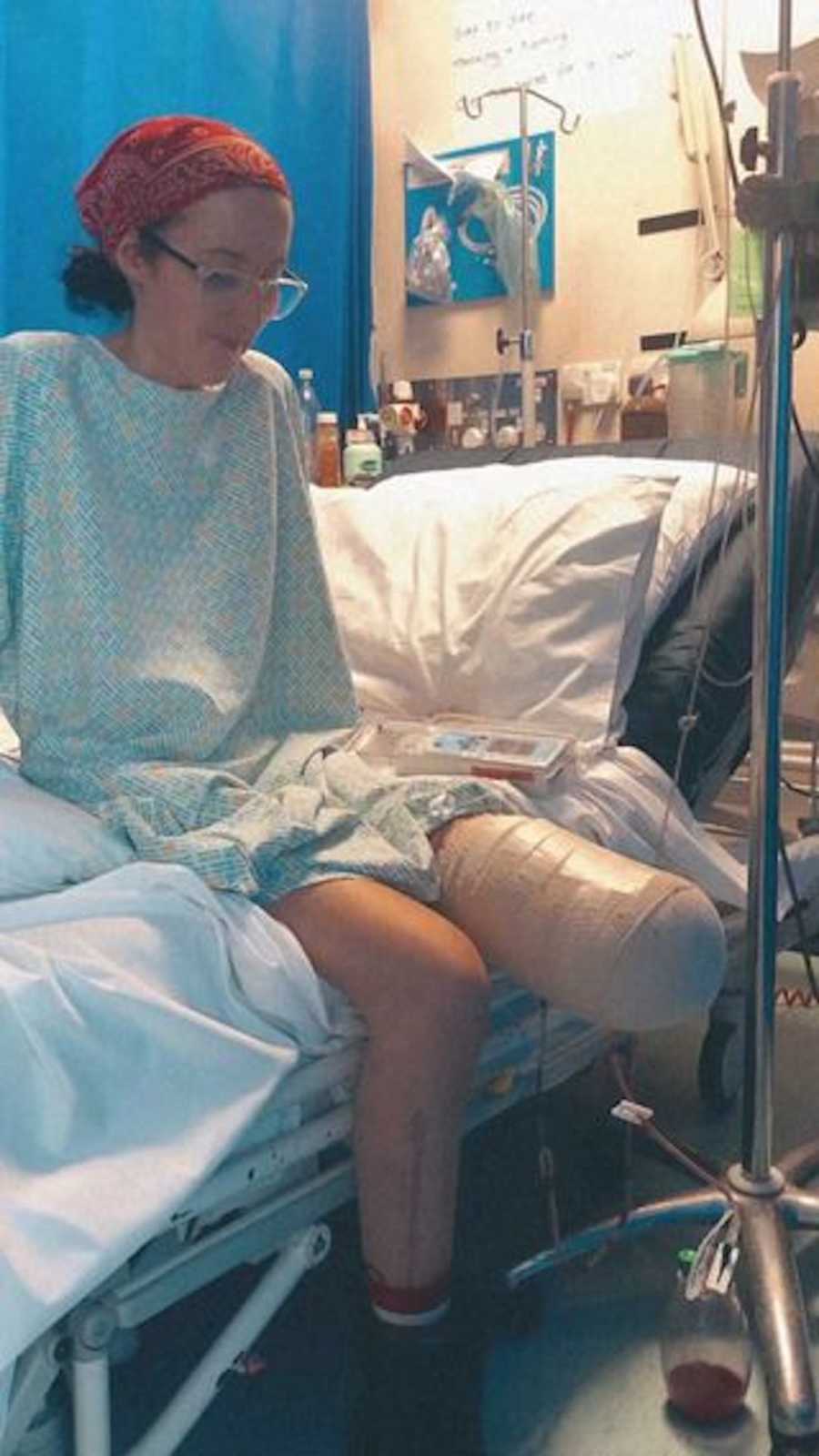 woman with lower part of left leg amputated in hospital bed