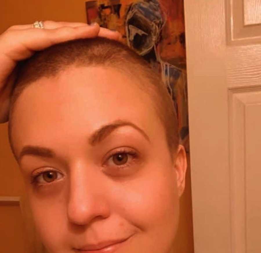 Woman showing chemo hair loss