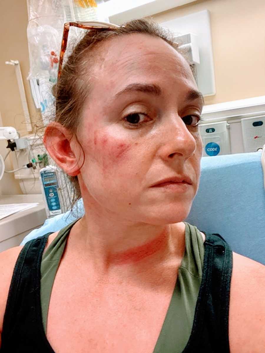 A woman with bruises on her face after getting injured
