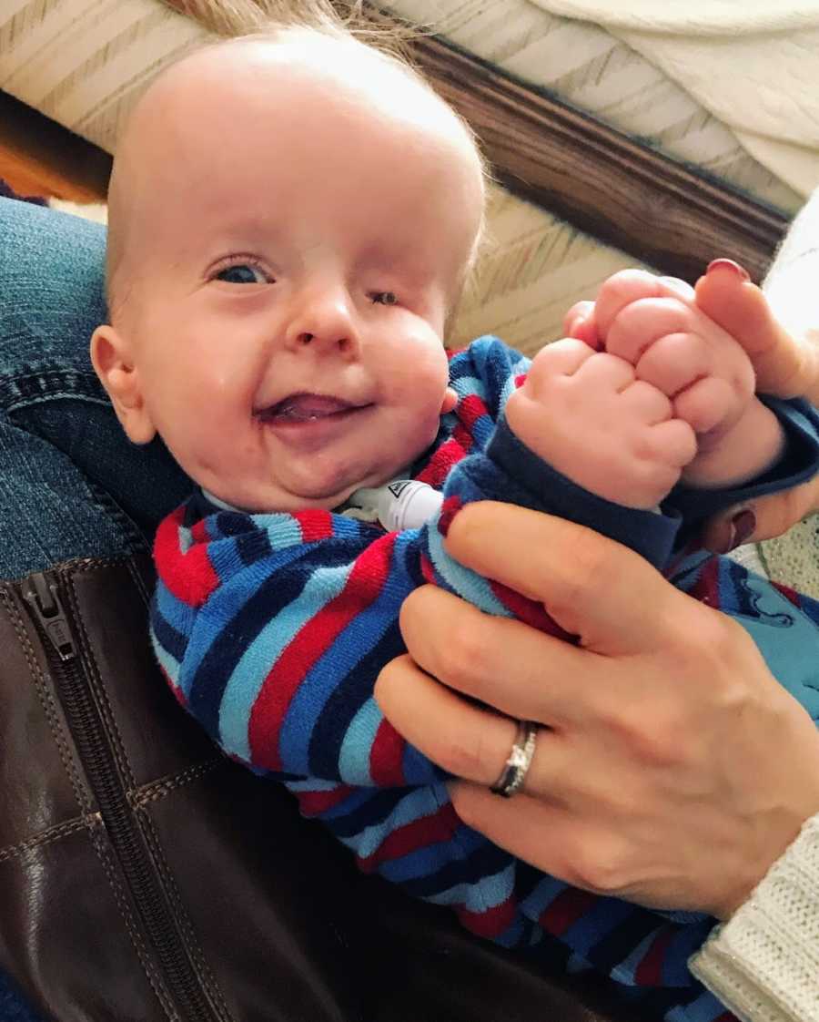 Baby boy with facial differences being held by parent