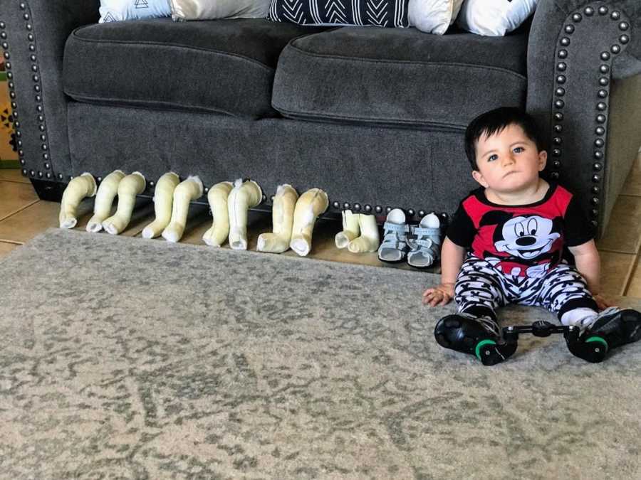 Baby boy posing with previous leg casts