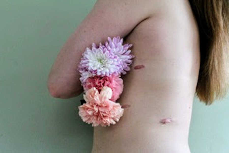 女人摆在胸部上摆着鲜花和手臂，露出肺部手术疤痕