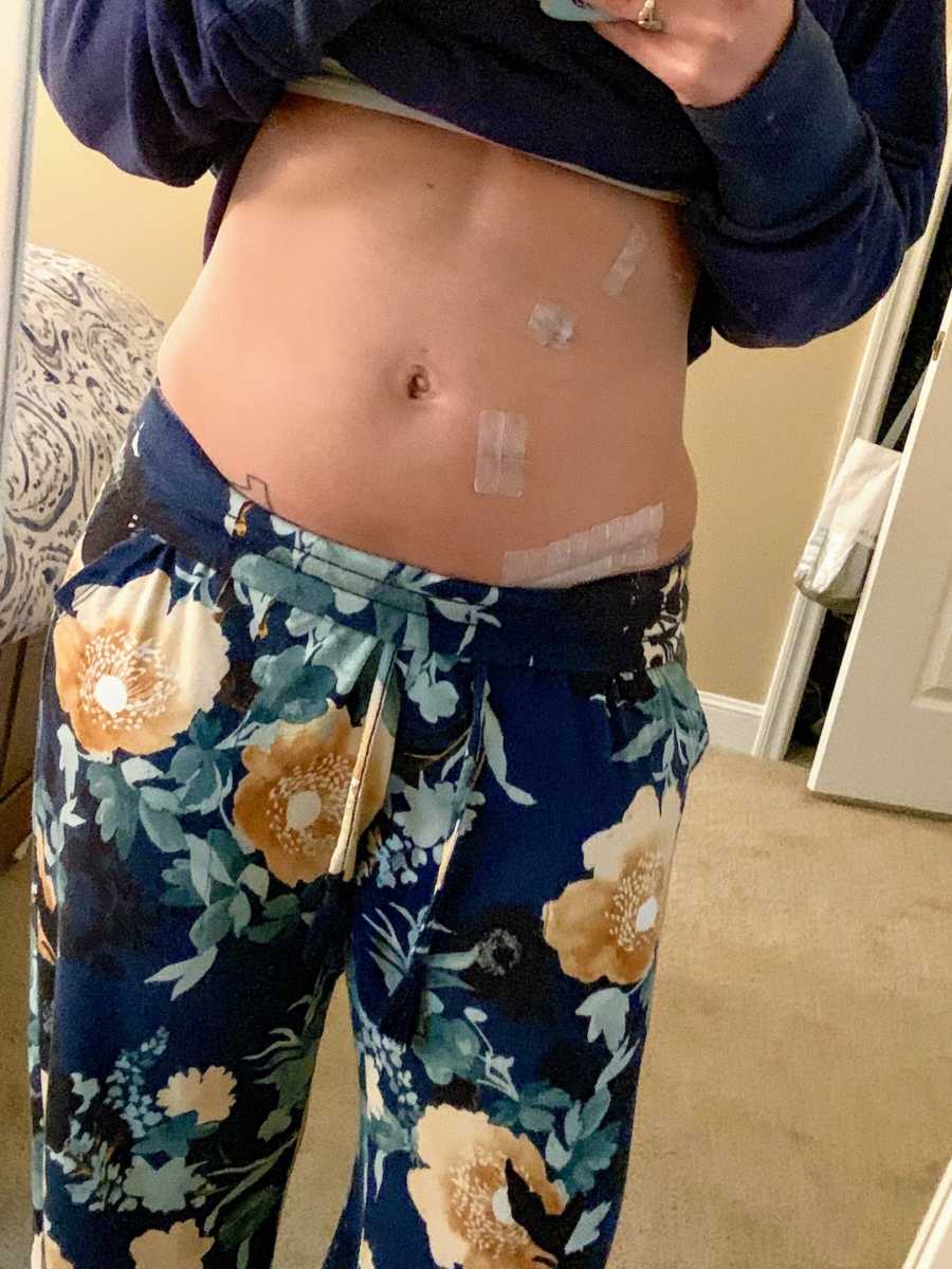 Woman's stomach after kidney surgery