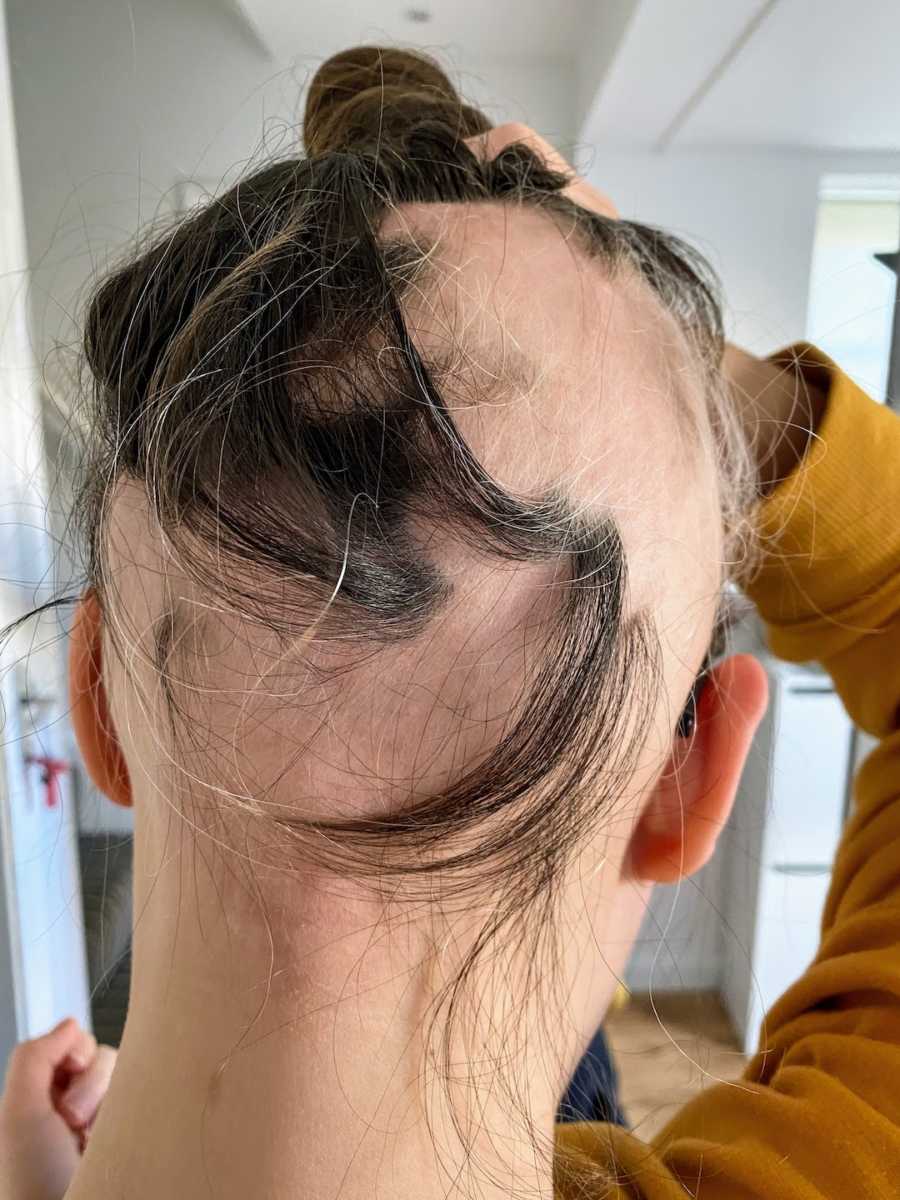 Woman showing bald patches on head due to alopecia