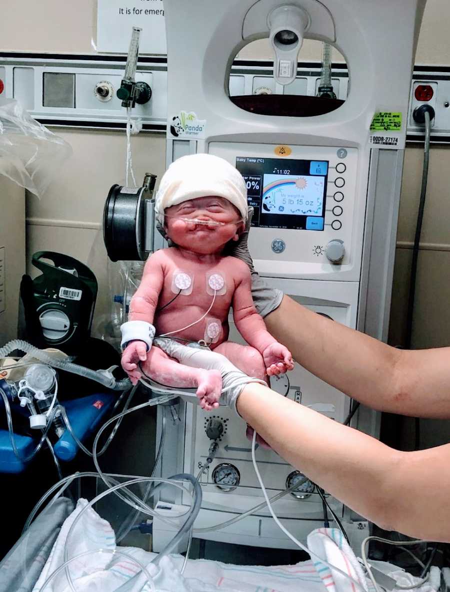 Nurse holds up newborn baby with rare Alobar Holoprosencephaly for a picture after birth