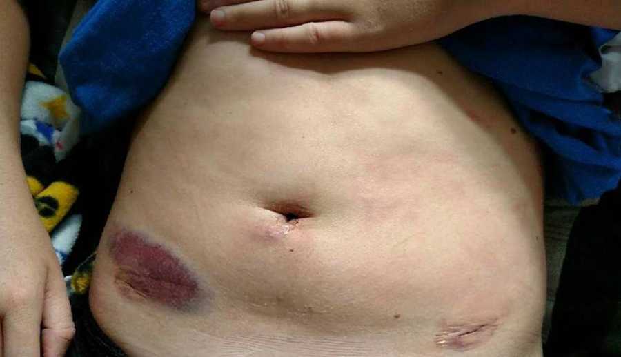 endometriosis scars post surgery