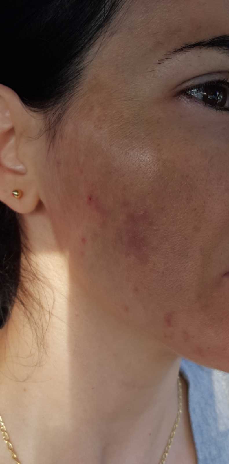 cystic acne on woman's face