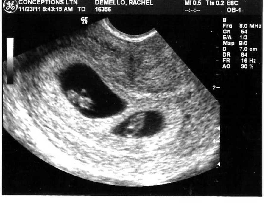 6 week ultrasound