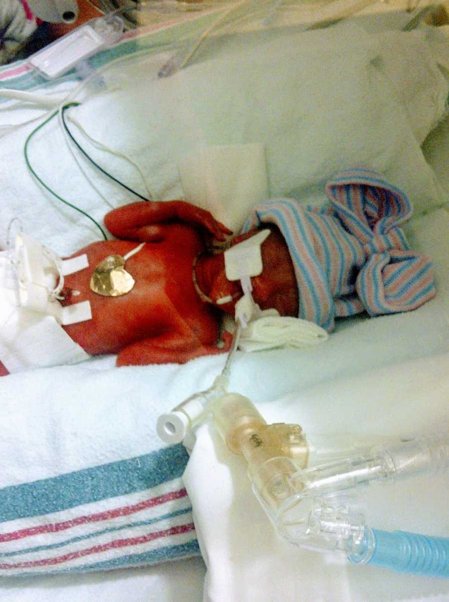 A preemie baby girl shortly after her birth