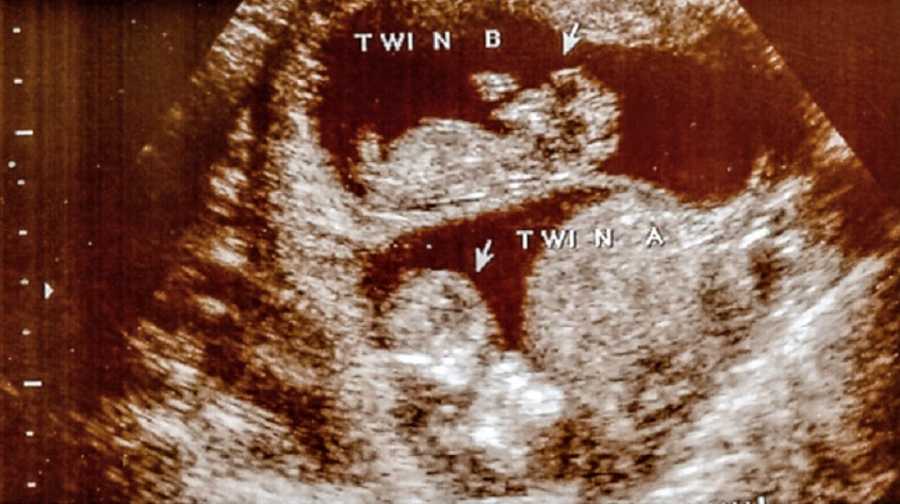 An ultrasound picture showing twin babies