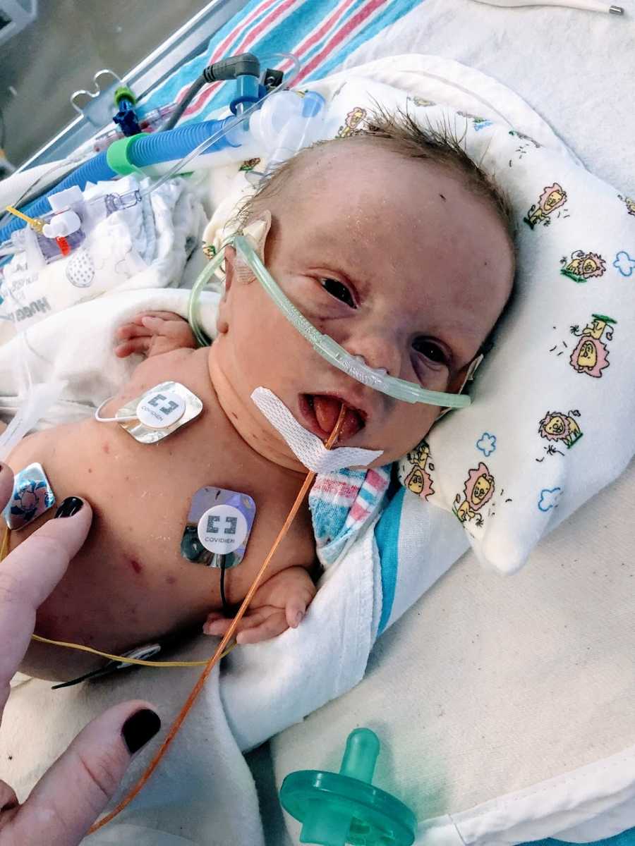 A baby boy with no arms lying in a hospital bed