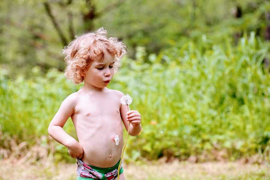 A little boy wearing a feeding tube blows on a dandelion