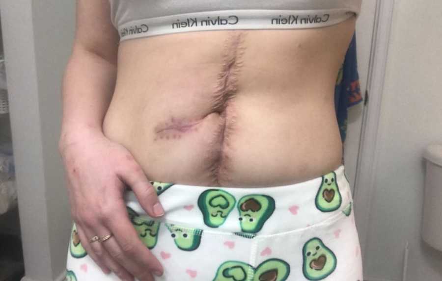 surgery scar on stomach
