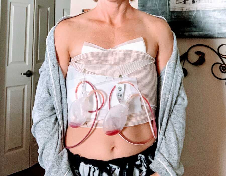 Woman recovering from Breast Implant Illness and emergency surgery takes a photo of her chest