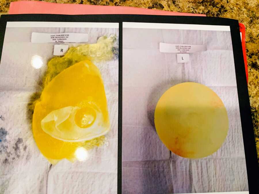 Woman suffering from Breast Implant Illness shows the difference between her left and right implants, the right one ruptured and 'gummy'