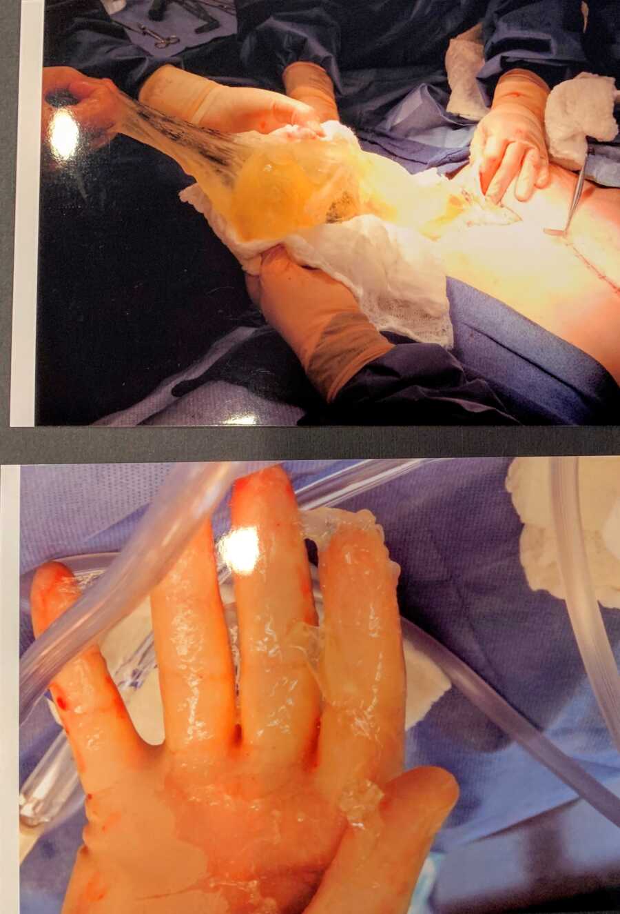 Photos of a woman in surgery getting her breast implants removed due to Breast Implant Illness and a ruptured implant