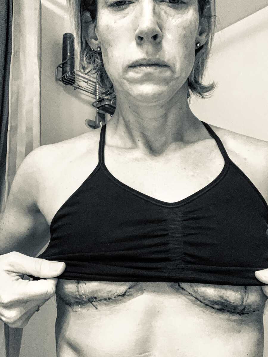 Woman recovering from emergency surgery due to Breast Implant Illness takes a photo of the scars and scar tissue under her breasts