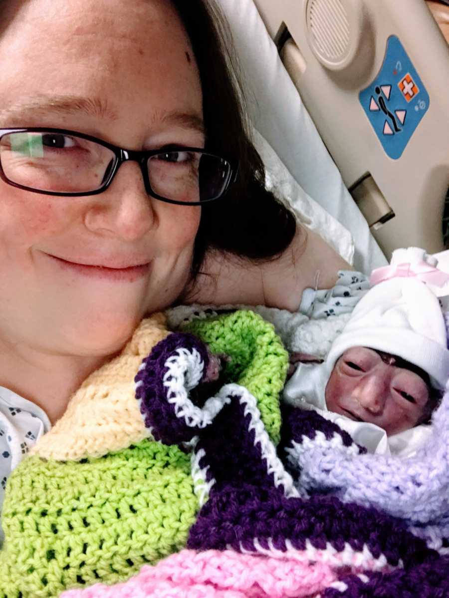 Woman holds her newborn daughter with anencephaly