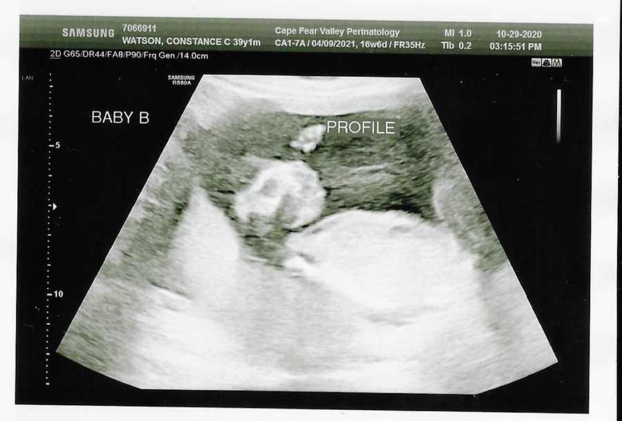 Ultrasound scan of Baby B in twin pregnancy reveals potential Anencephaly