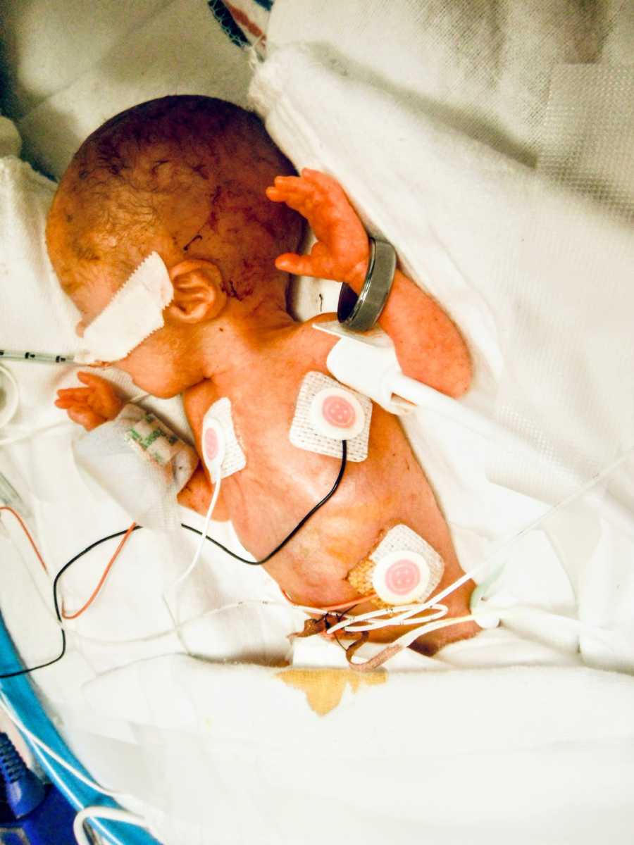 Preemie born at less than 3 pounds fights for her life in the NICU