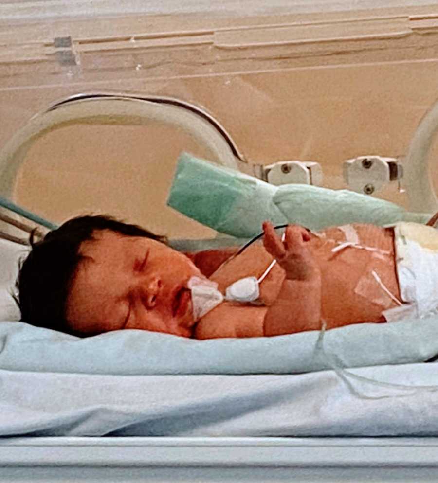 Little boy born with a limb difference sleeps in the NICU ward