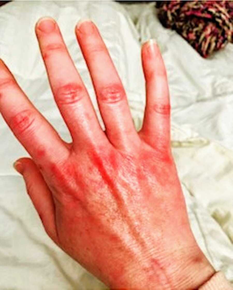 Woman battling unknown illness takes a photo of her stiff, red hand