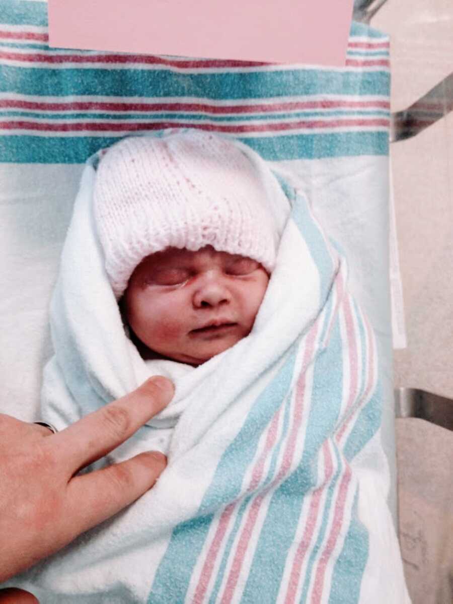 Newborn baby girl with dwarfism sleeps in the hospital while swaddled up in a blanket