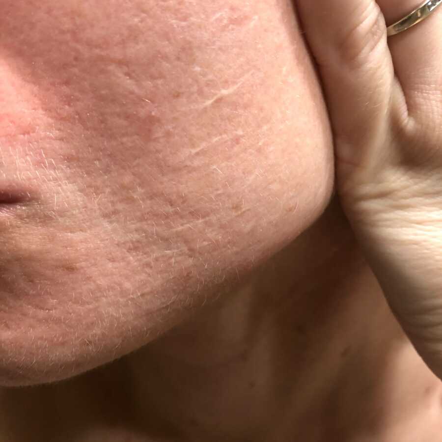 woman showing acne scarring