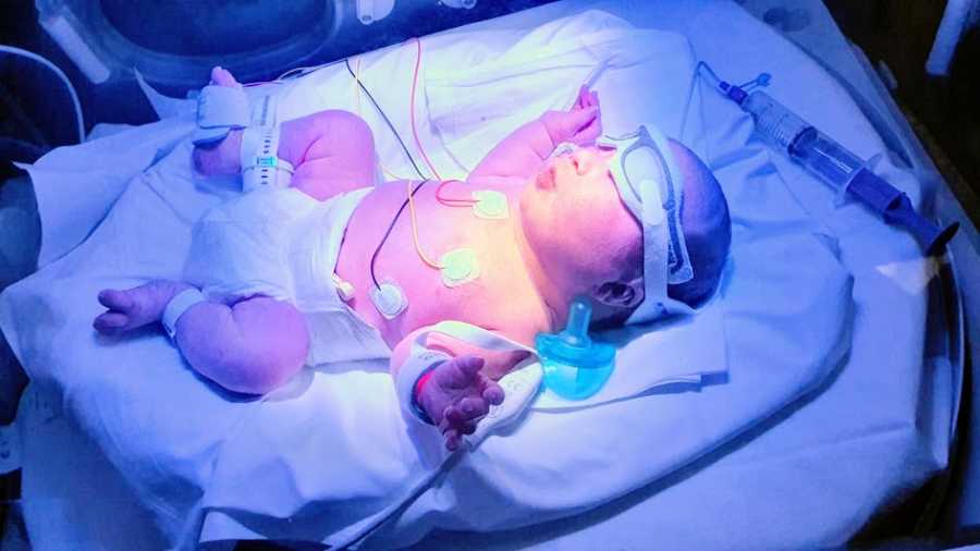 A baby lies on her back in the NICU