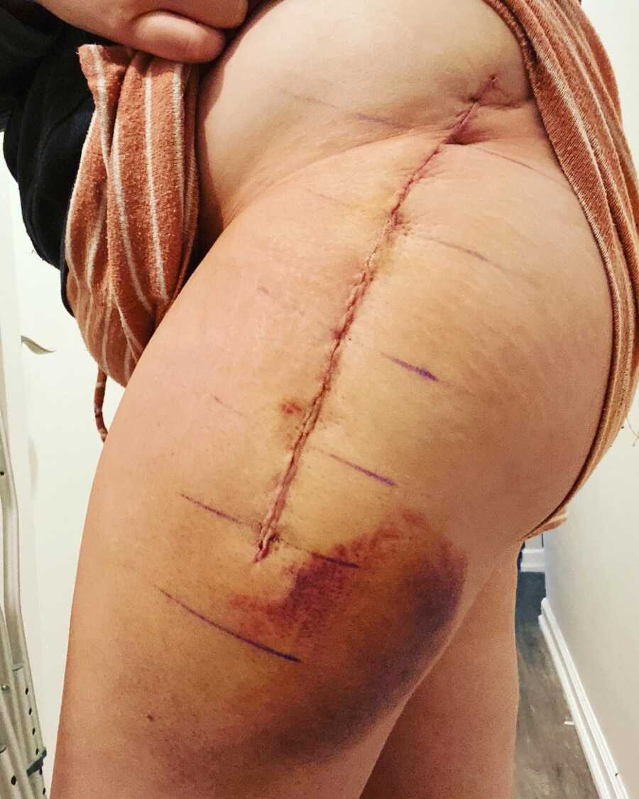 scars on woman leg