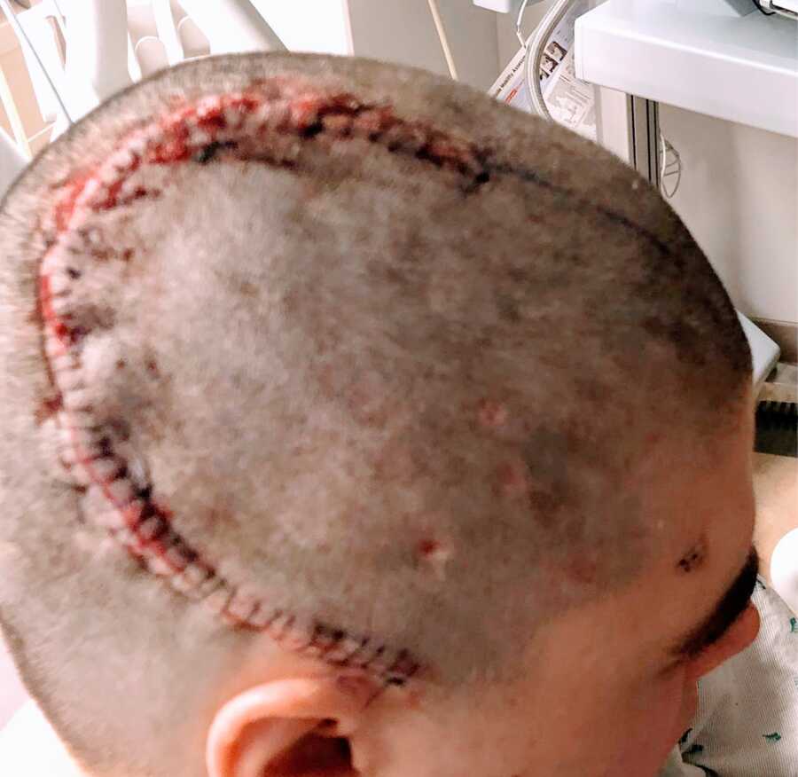 woman with stitches after surgery