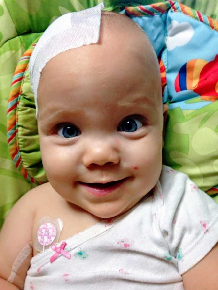 Little girl with hydrocephalus looks into the camera with her big beautiful blue eyes and a bandage on her head