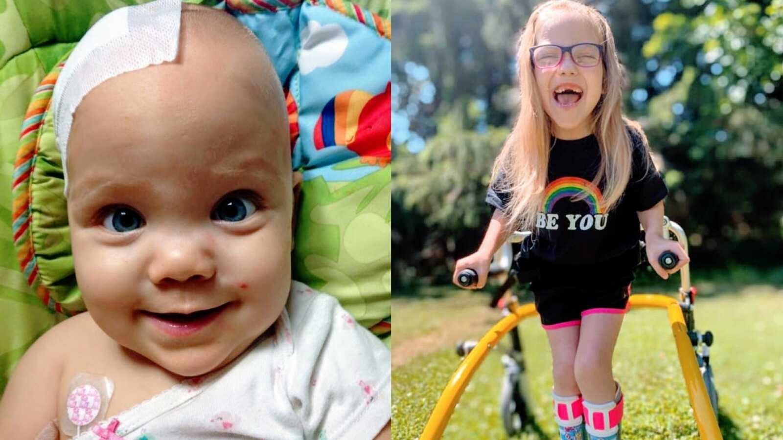 Special needs mom shares photos of daughter with cerebral palsy, one from after brain surgery as a baby and one now as she walks with a walker